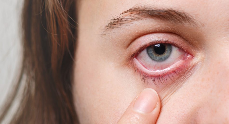 6. Conjuntivitis