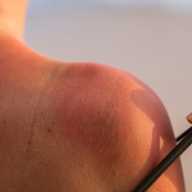  Enfermedades más comunes en verano: cuáles son y cómo prevenirlas